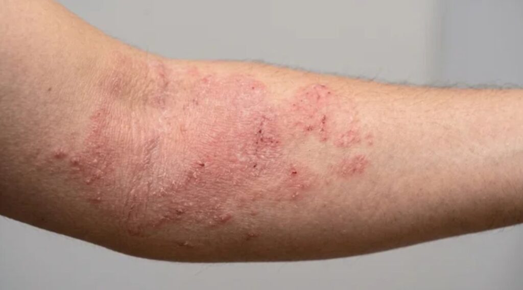 Más del 10% de la población en México vive con dermatitis atópica; expertos analizan su relación con otras enfermedades inflamatorias